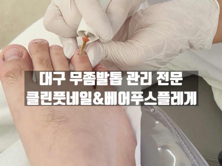 대구 내당동 무좀발톱 케어전문 클린풋&네일(문제성 손발톱 관리) 대구 내당동 무좀발톱 케어전문 클린풋&네일(문제성 손발톱 관리)