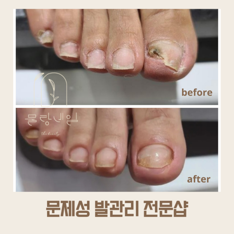 대전무좀발톱 병원가서뽑는것만방법?