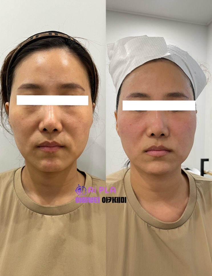  대구 AI플라즈마 써마지 피부관리 페이스리프팅 효과,아미뷰티