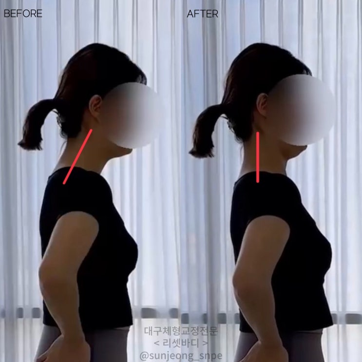  거북목이 너무 고민이라면 대구 리셋바디