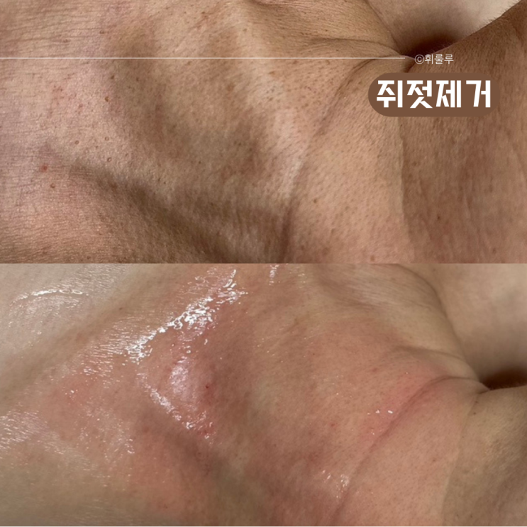 창원피부관리 진해용원 쥐젖 편평사마귀 제거 혜리온에스테틱