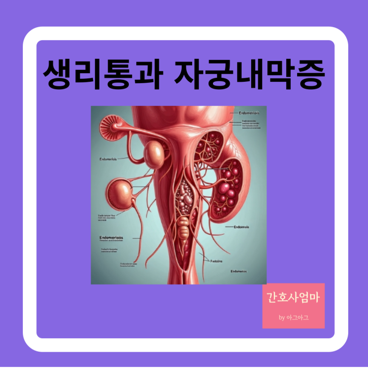  생리통이 심한 원인과 자궁내막증의 증상
