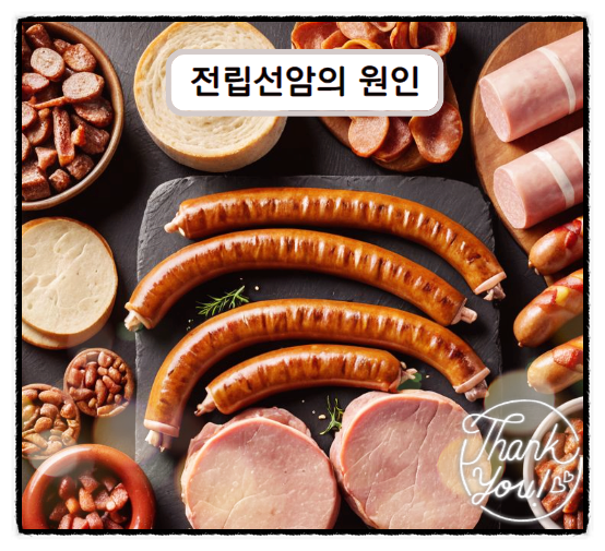  전립선암4기 생존율 높이려면