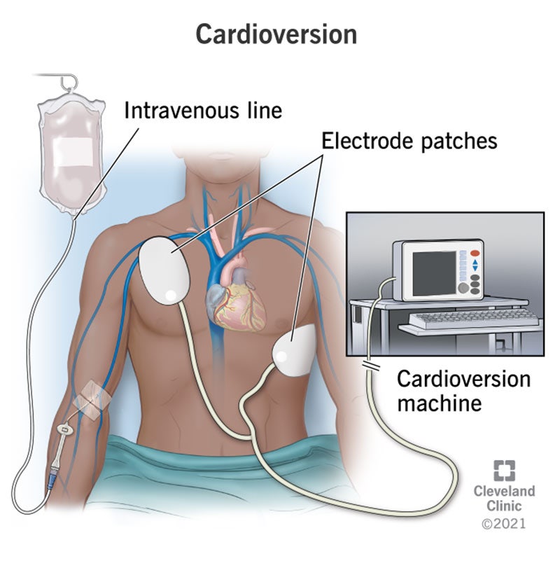 제세동기 : Defbrillation과 Cardioversion : 네이버 블로그