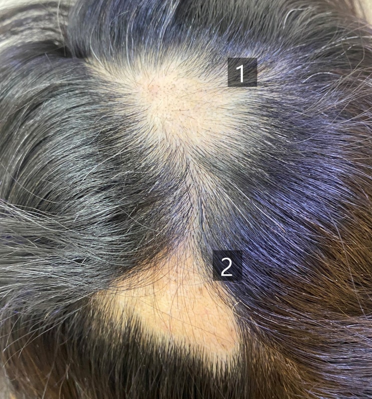  발모벽(trichotillomania)으로 인한 탈모증, 어떻게 치료해야 할까요?