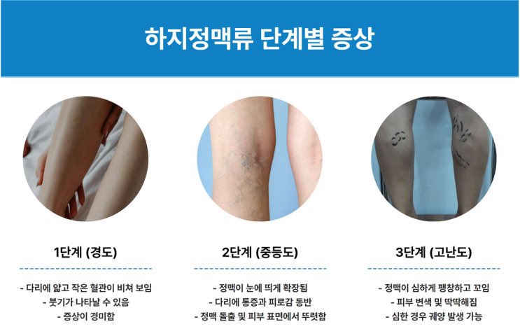  흉터와 통증을 최소화? 우주통증의학과 하이브리드 하지정맥류 시술