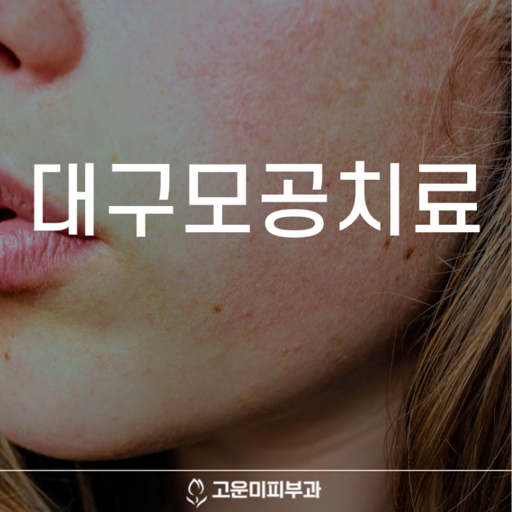  대구모공치료 넓어진 모공 원인에 따른 맞춤 시술 고운미 피부과 모공치료 프로그램