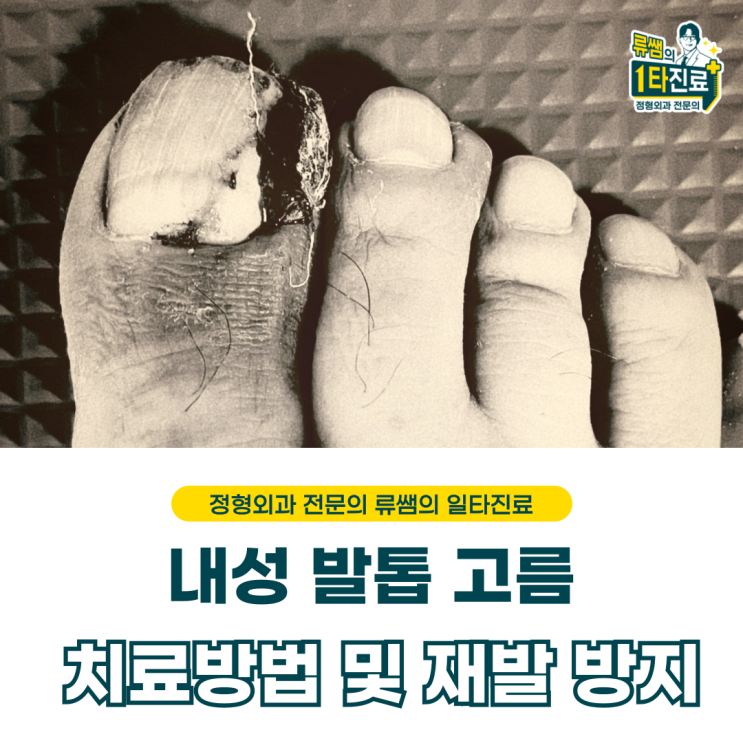  엄지발가락 내성발톱 고름, 관리 방법 및 재발 방지법법 (의사작성)