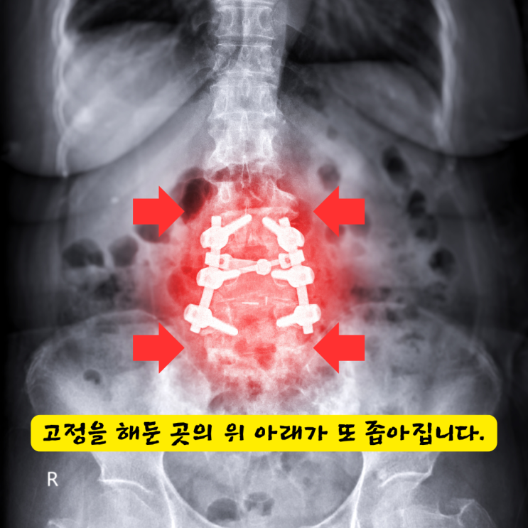  서면신경외과, 협착증 시술 후에도 걷기 힘든 분만 보세요.