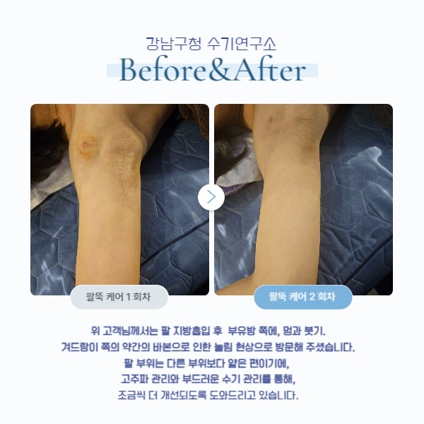  팔뚝 지방흡입 고주파 관리 상황 별 케어 진행 후기