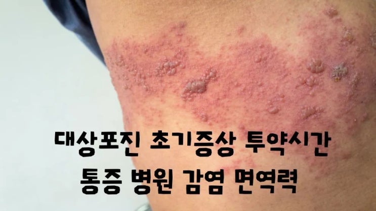  대상포진 초기증상 투약시간 통증 병원 감염 면역력