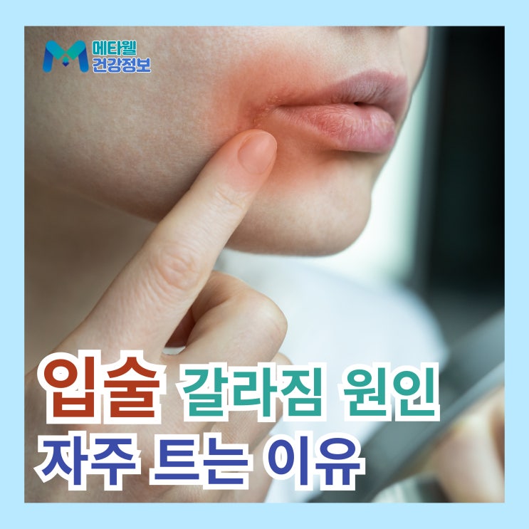  입술 끝 갈라짐 건조함 증상 원인 입술이 자주 트는 이유