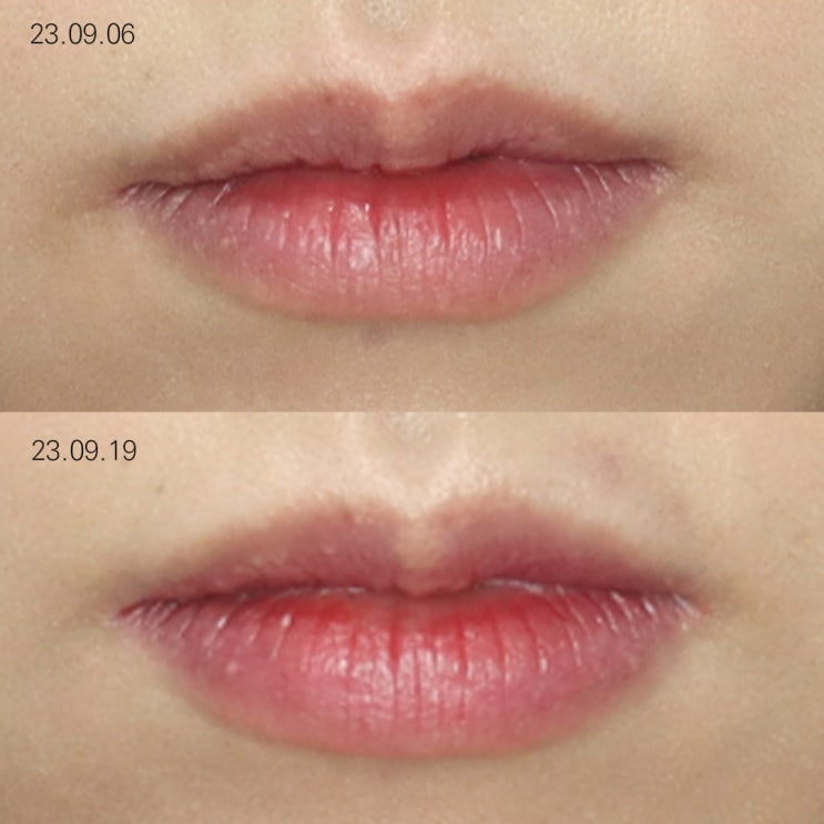 부산 필러잘하는곳 ? OO만 기억하세요 부산 필러잘하는곳 ? OO만 기억하세요