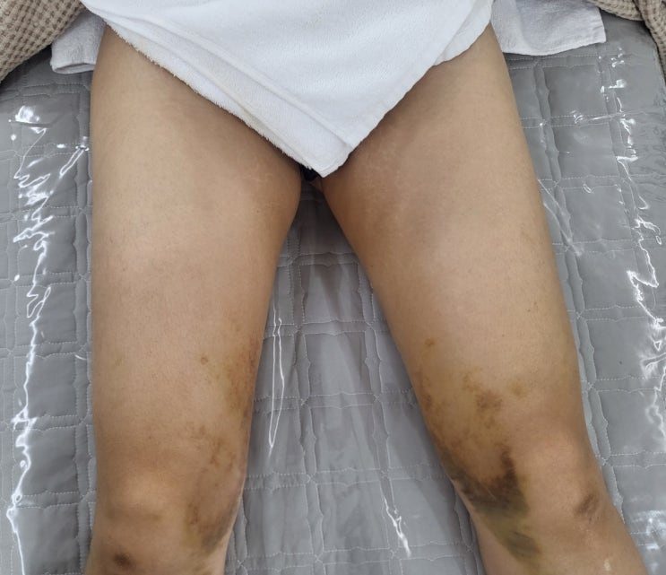  허벅지 지방흡입 후관리-멍, 붓기, 통증 고주파~엔더몰로지까지
