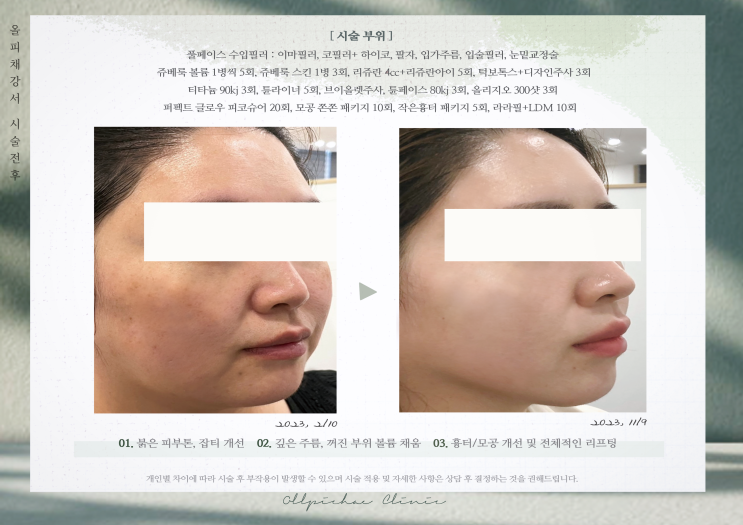  김포피부과 고주파/초음파 리프팅 후기