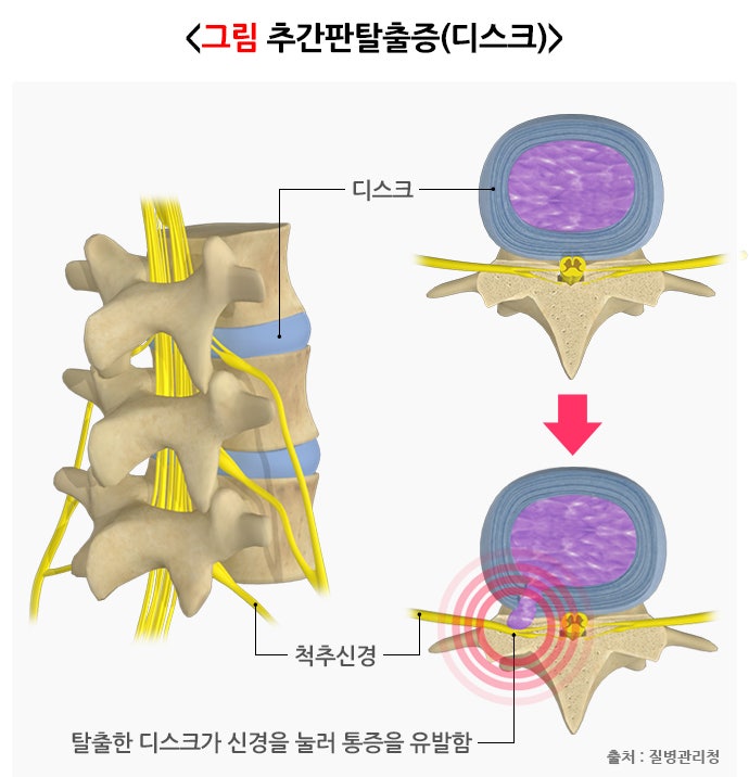 추간판 탈출증(디스크) 원인, 증상, 치료 및 예방법, 좋은 운동 총정리 : 네이버 블로그