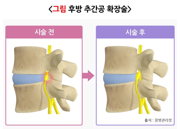 추간판 탈출증(디스크) 원인, 증상, 치료 및 예방법, 좋은 운동 총정리 : 네이버 블로그