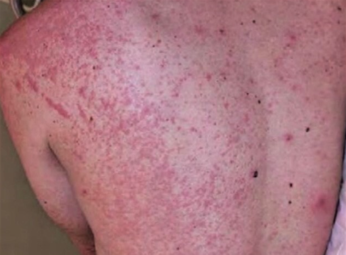  엠폭스 (Mpox), 원숭이 두창 확산, 엠폭스란? 예방방법 및 관련주 정리