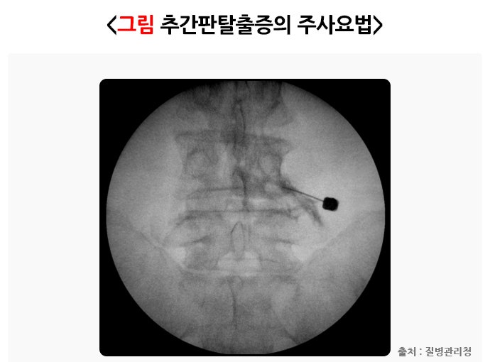 추간판 탈출증(디스크) 원인, 증상, 치료 및 예방법, 좋은 운동 총정리 : 네이버 블로그