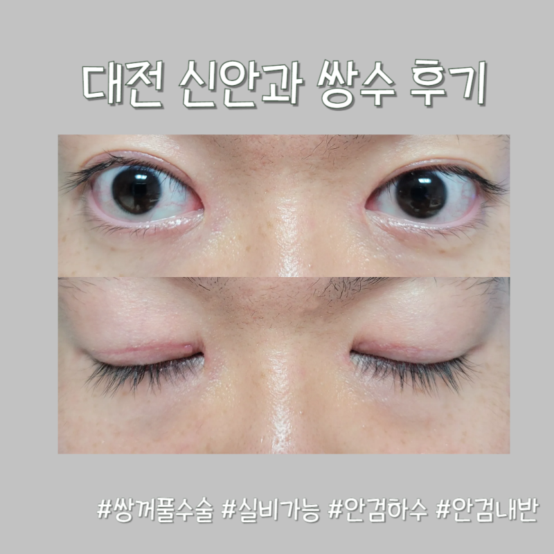 [대전신안과]남편 안검내반&앞트임 수술 후기_가격, 수술사진, 실비, 주차 등 신안과 모든 정....
