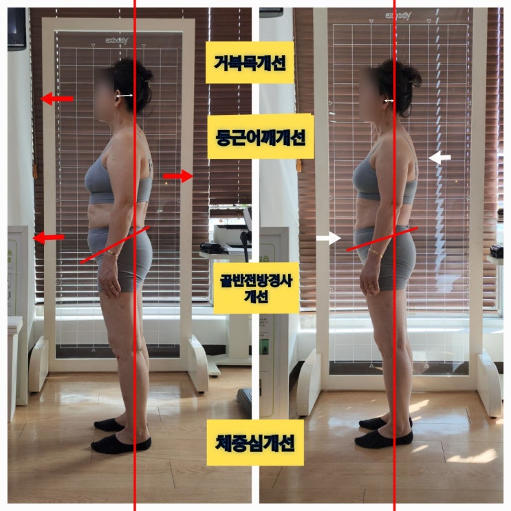  [동래 사직동 재활 필라테스] 척추협착증 치료 및 무릎통증 개선 후기