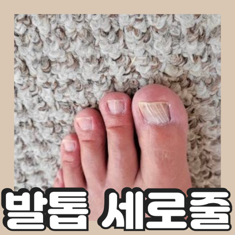 발톱세로흰줄 검은세로줄과 흑색종의 발생이유