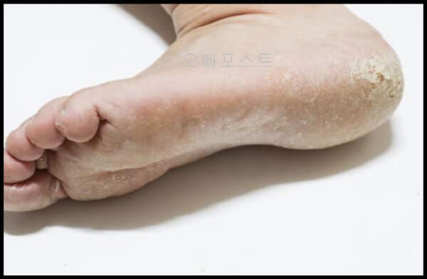  무좀 치료법 3가지와 발바닥 무좀 증상 상세히 알아보기
