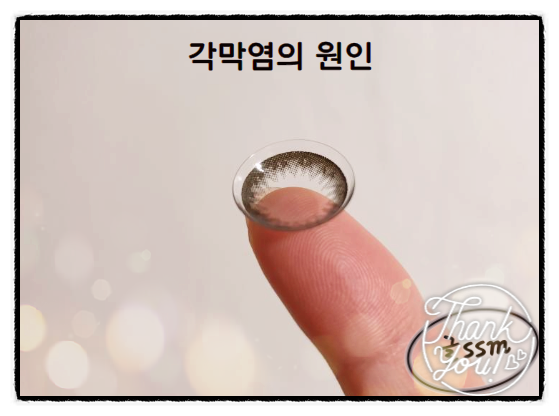  각막염증상 예방과 관리