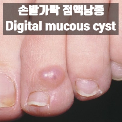  손발가락에 투명한 덩어리가 생겼어요. -  손발가락 점액낭종(Digital mucous cyst)