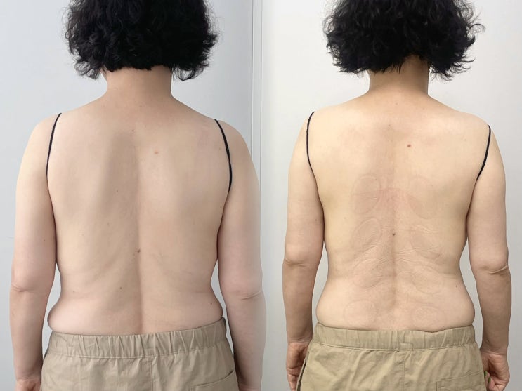  부천 부평 피부관리 뷰티선셋 / 목과 어깨 통증의 근본 원인은? 등 관리로 통증잡고 승모근라인도 예뻐지자!