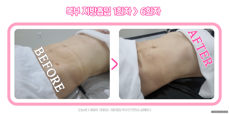  지방흡입 전후 차이! 복부 바이오본드 관리 6회차