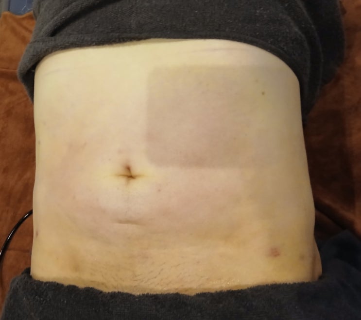  복부 바이오본드 팔 허벅지 보다 관리가 어려운 이유 2가지