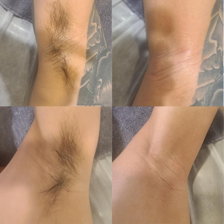  남자 겨드랑이 왁싱으로 땀냄새 안녕, 남자 전문 왁싱샵 "청춘케어"