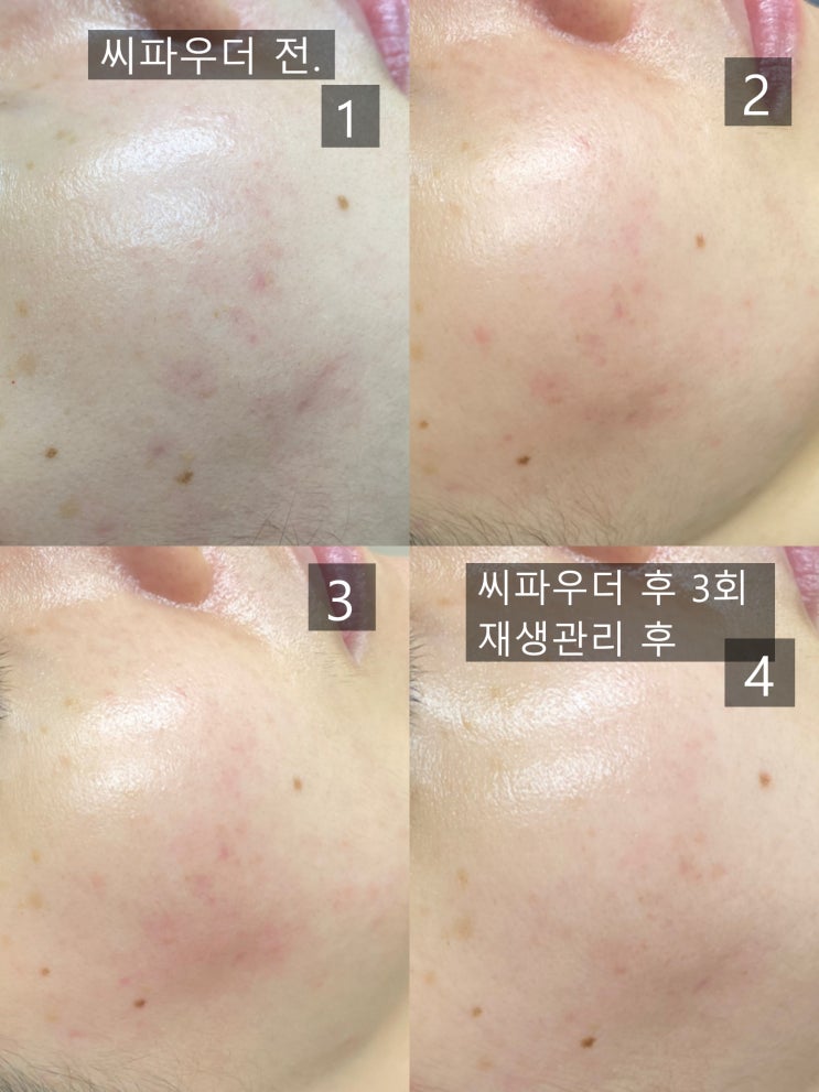  부천역피부관리 복합적인 피부 문제와 여드름흉터 개선 사례
