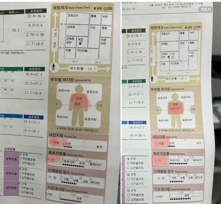  뒷구리 상체다이어트 이오팻 후기 - 강남 지방분해주사가격 통증
