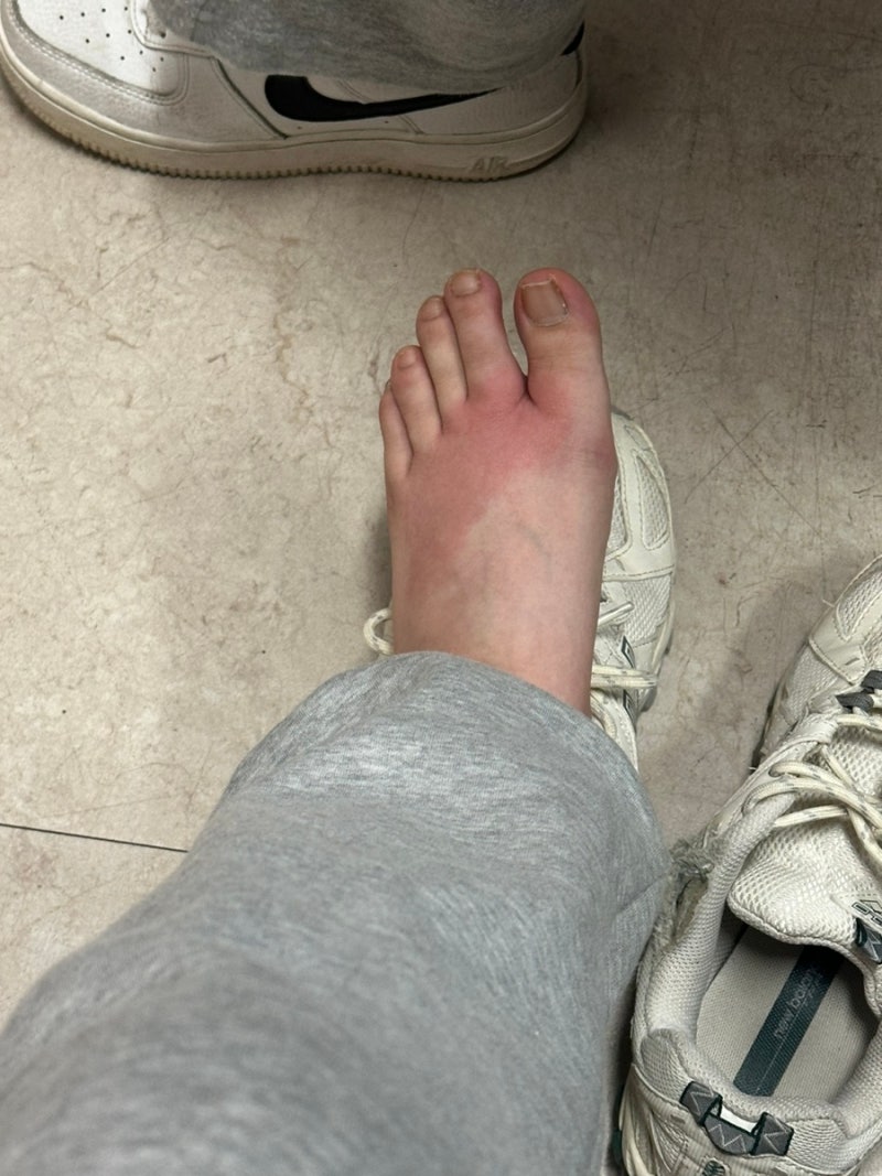 지네 물림 치료 후기 / 지네에 물렸어요!