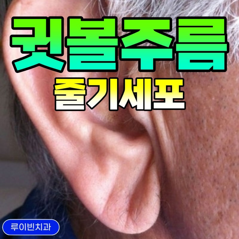 귓볼 세로 주름(귀옆주름) 귀주름 생겼을때 증상 원인치료 병원