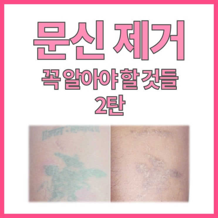  문신제거를 원하신다면 꼭 아셔야 할 것들 - (2/2)