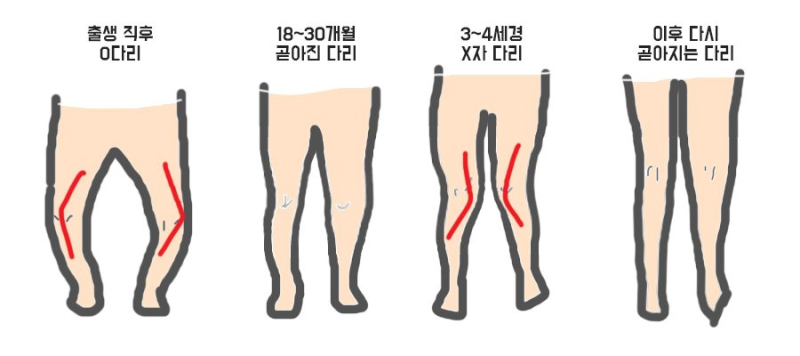 아기 다리 휨, 휜다리 교정법 신생아 오다리 엑스자다리 원인 소아 안짱다리