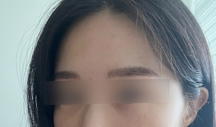  눈밑지방재배치 일주일차 후기 출혈 없었어요(미세지방이식 포함)