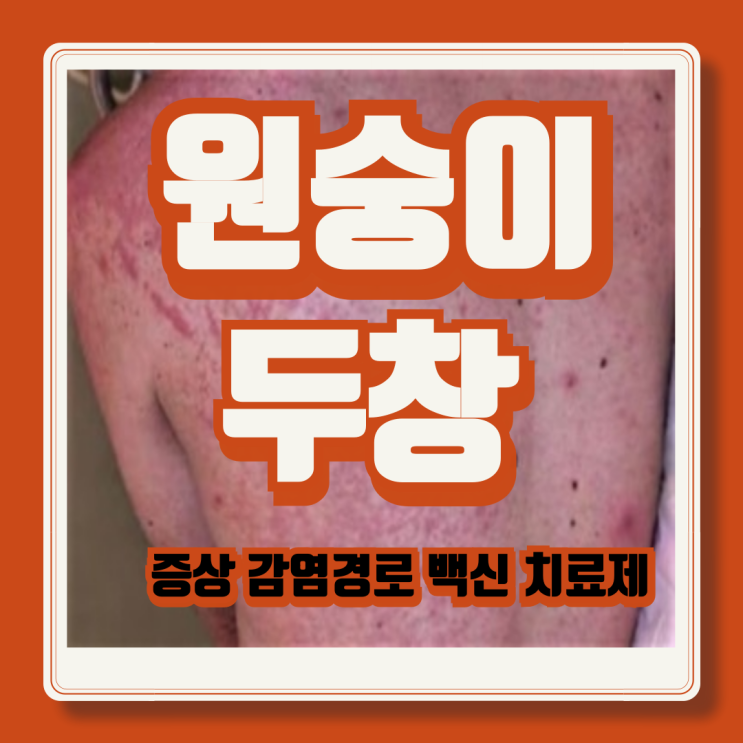  엠폭스 감염경로 증상 예방접종 백신 치료제 총정리