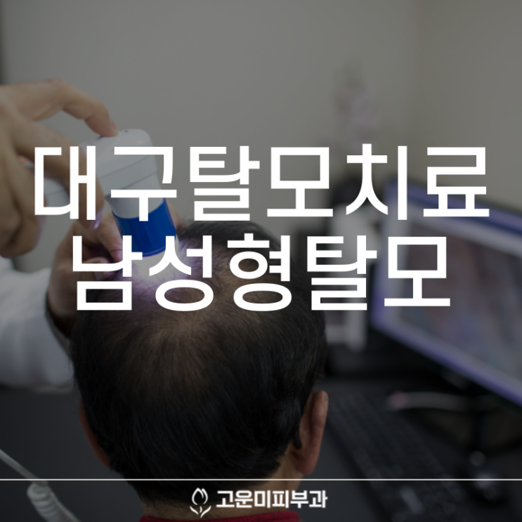  대구탈모치료 남성형 탈모 진행 단계에 따른 고운미 피부과의 탈모치료 프로그램