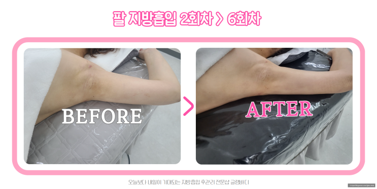 팔 지방흡입 후 붓기, 바이오본드 관리 6회차 드라마틱한 전후 차이