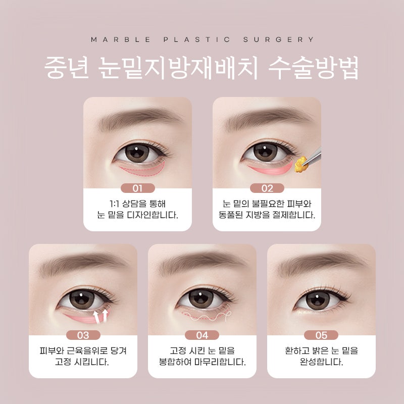 눈 밑 지방 재배치량의 핵심은 무엇인가요?