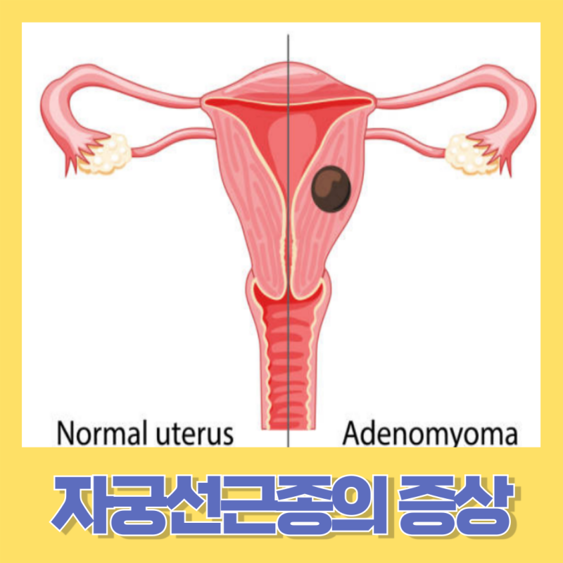 자궁선근종의 증상과 진단 치료와 관리법