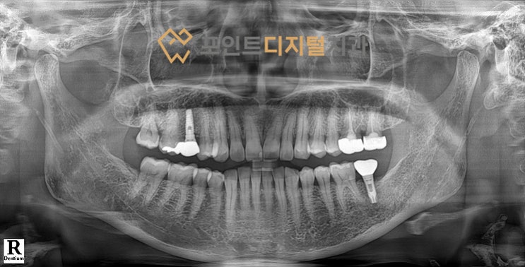  [탕정치과] 임플란트 20년 경과(3i 임플란트) / 천안 아산
