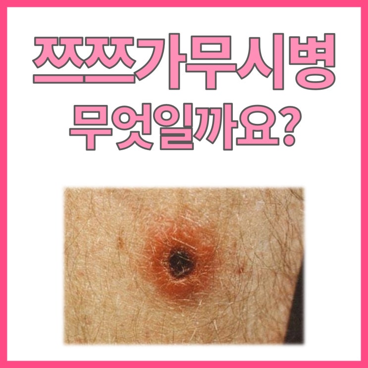  가을철 벌레에 물리고 나서 뭐가 생긴다면, 쯔쯔가무시병(Tsutsugamushi)을 의심해 보세요