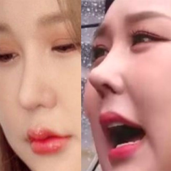 바뀐 풍자 코 변천사? 코수술 회복기? (+ 과사 직선코, 직반라인, 자려한, 반버선)