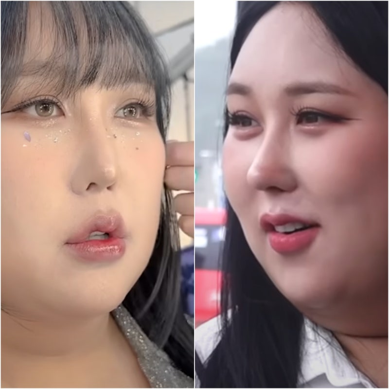 풍자 코수술 과거 VS 현재 부작용 재수술 주의사항