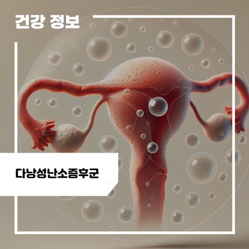 다낭성 난소 증후군 증상 및 원인, 피검사, 치료 방법